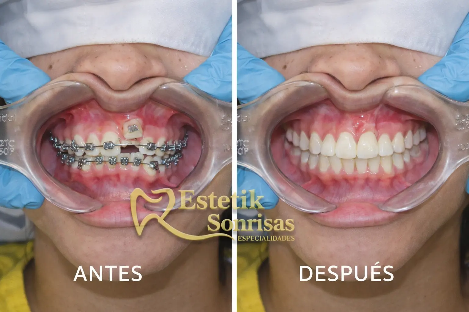 Resultado de Ortodoncia Avanzada