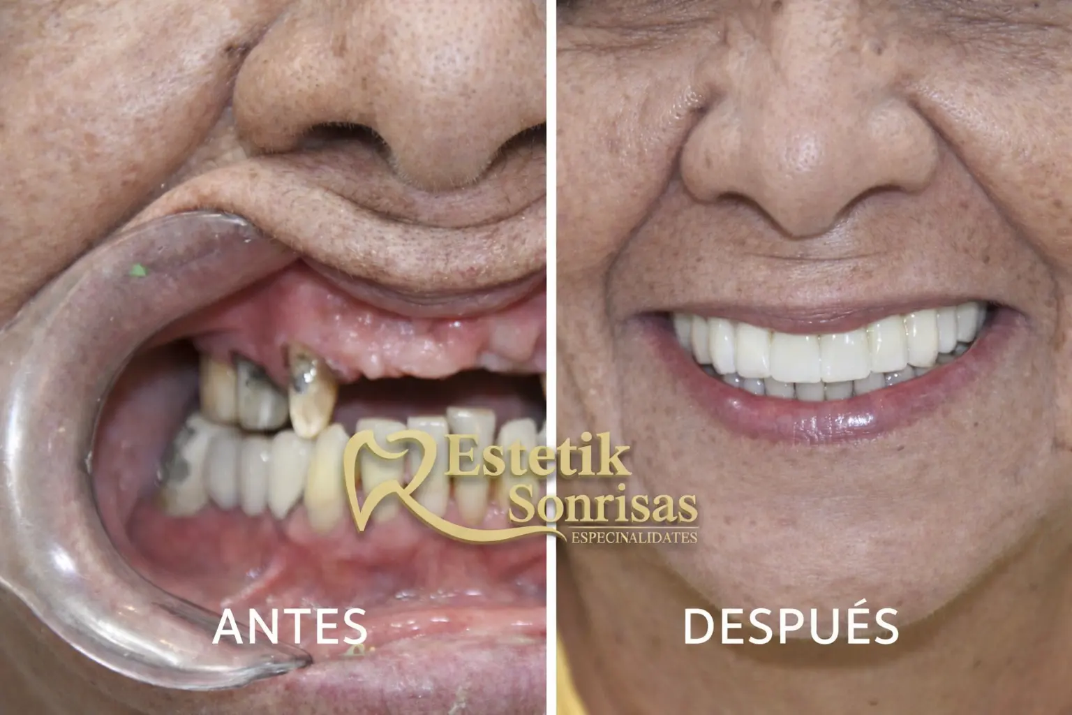 Resultado de Implantes Dentales Inmediatos